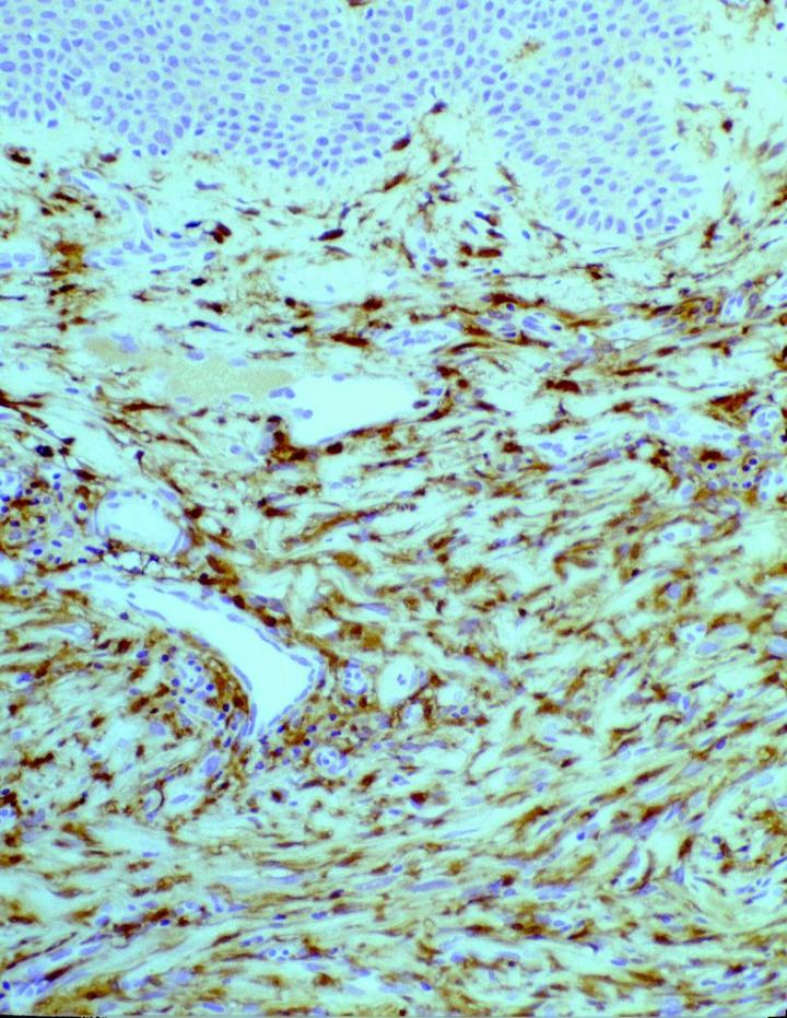 图 2. 通过抗 FXIIIa 抗体检测的皮肤纤维瘤 (DF) 细胞标记结果表明良性肿瘤细胞中存在广泛阳性分布。 放大 60 倍。