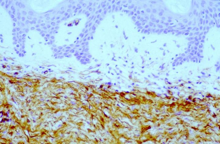 图 4. 抗 CD34 抗体检测显示隆突性皮肤纤维肉瘤 (DFSP) 中存在阳性标记的侵袭性纺锤体状肿瘤细胞。 放大 60 倍。