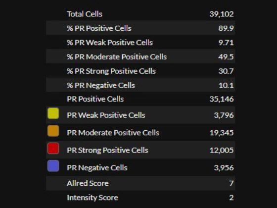 Breast PR AI for Breast Cancer Sample Analysis