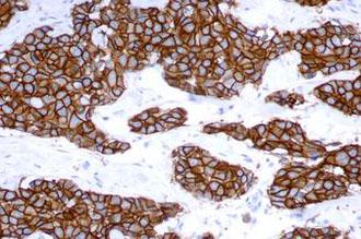 Human breast carcinoma: immunohistochemical staining for c-erbB-2 oncoprotein using Bond Oracle HER2 IHC System. Note intense membrane staining of tumor cells. Paraffin section.