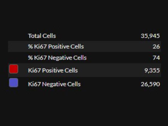 Breast Ki67 AI quantitative results 