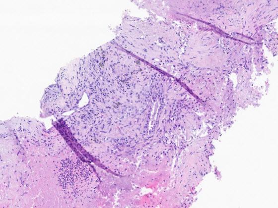 H&E stained tissue with folds H&E stained tissue with folds