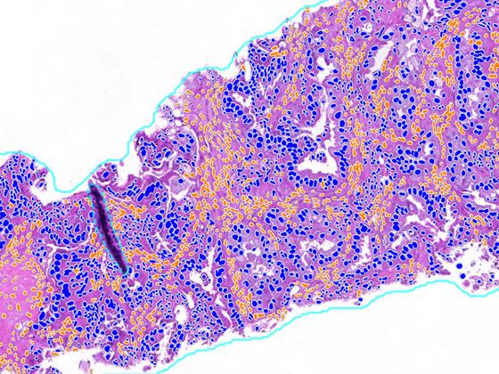 Lung Macrodissect AI scoring markup Lung Macrodissect AI scoring markup