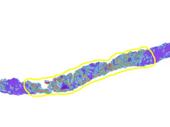 Lung Macrodissect AI tumor heatmap Lung Macrodissect AI tumor heatmap