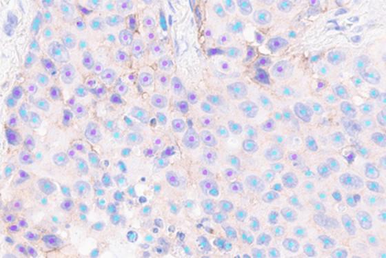 Instant and automated identification of PD-L1 positive and negative tumor cells Instant and automated identification of PD-L1 positive and negative tumor cells