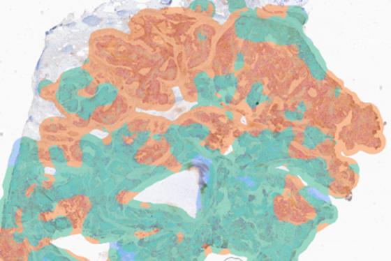 Visualization of PD-L1 expression on the heatmap Visualization of PD-L1 expression on the heatmap