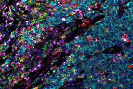 Breast cancer tissue