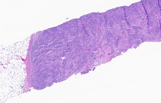 Step 1: Breast Cancer H&E Image