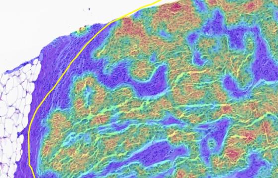 Step 2: Tumor Density Heatmap (Higher Resolution)