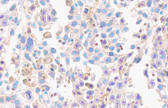 Instant and automated identification of PD-L1 positive and negative tumor cells & immune cells