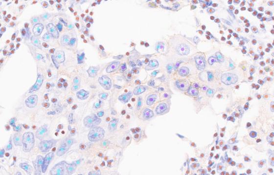 Instant and automated identification of PD-L1 positive and negative tumor cells & immune cells