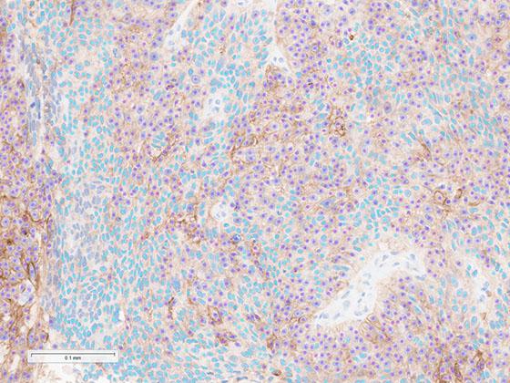 Lunit-SCOPE-PD-L1-CAL10-NSCLC-PDL-1-Cell-Counts-for-Workflow