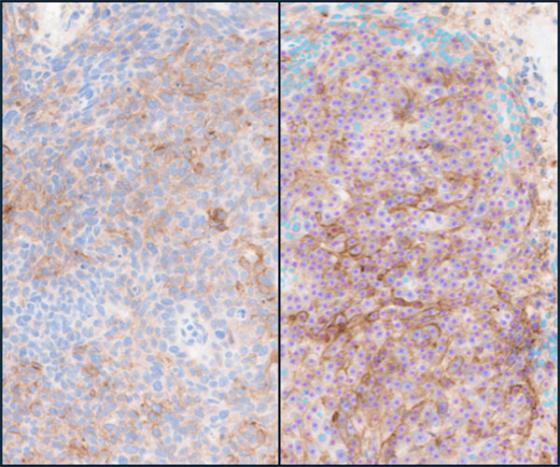 Lunit-SCOPE-PD-L1-CAL10-NSCLC-Positive-Negative