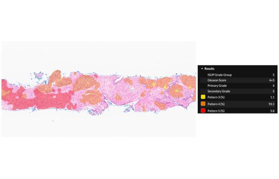 DeepDx-Prostate-ivd-feature