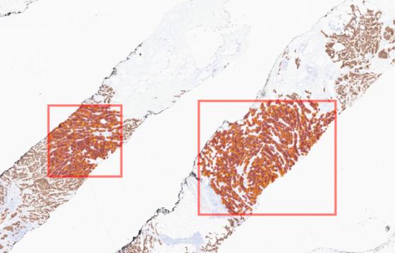 mindpeak_her2_ruo_02_annotation_subregion_analysis