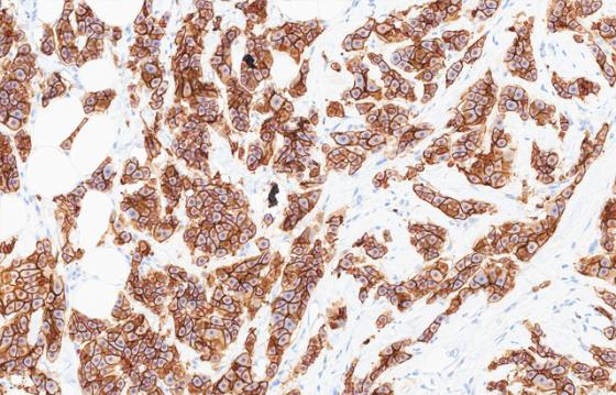 mindpeak_her2_ruo_04_ihc_field_ai_markup