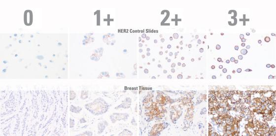 Refer fewer cases to FISH. Crisp Staining with the added confidence of four control cell lines makes it easier to correctly discriminate between 1+ and 2+ cases.