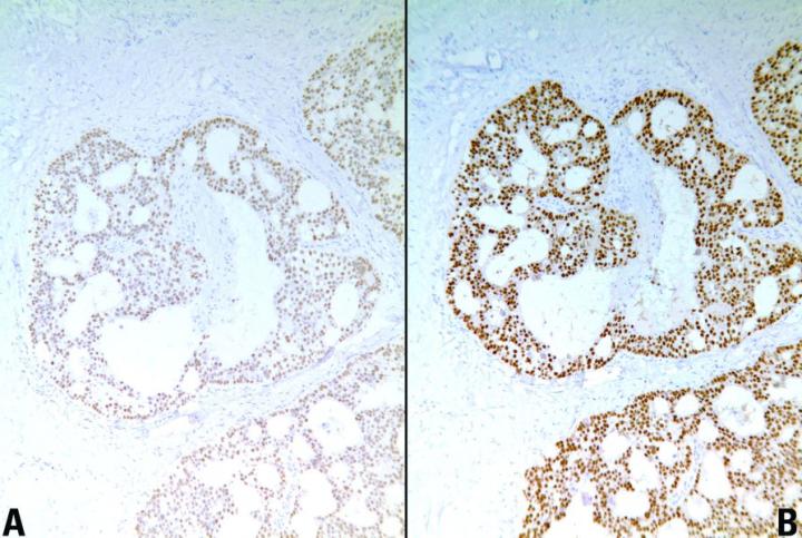 Figure 1. Estrogen receptor (ER) staining of breast carcinoma. A. Tissue block fixed for 3 hours in 10% formal saline showing weak demonstration of ER positive cells. B. Tissue block fixed 8 hours in 10% formal saline showing strong demonstration of ER positive cells. Figure 1. Estrogen receptor (ER) staining of breast carcinoma. A. Tissue block fixed for 3 hours in 10% formal saline showing weak demonstration of ER positive cells. B. Tissue block fixed 8 hours in 10% formal saline showing strong demonstration of ER positive cells.