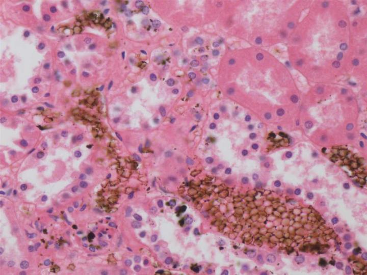 Figure 2: A formalin-fixed paraffin section of kidney showing the typical deposition of acid formaldehyde hematin (formalin pigment) associated with red blood cells. The pigment is brown to black in color and is birefringent under polarized light. In this case the specimen remained in fixative for an extended period before processing.