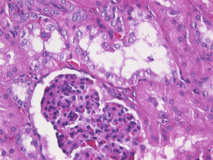 Figure 2: A paraffin section of kidney that has been fixed using neutral buffered formalin. This is an example of poorly-fixed tissue showing inferior nuclear and cytoplasmic morphology with excessive shrinkage and poorly defined cell margins. Note the vacuolation and fragmentation of both nucleus and cytoplasm of cells of the distal tubule and retraction of the glomerulus due to shrinkage.