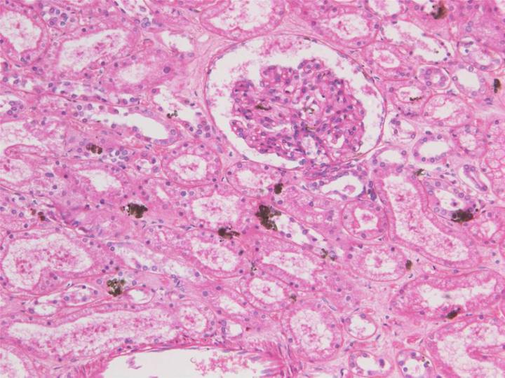 Figure 2: A section of kidney that contains randomly distributed greenish-brown deposits, an artefact produced when mercuric chloride is a component of the fixative used. In this case the section was not treated to remove the deposit prior to staining. Figure 2: A section of kidney that contains randomly distributed greenish-brown deposits, an artefact produced when mercuric chloride is a component of the fixative used. In this case the section was not treated to remove the deposit prior to staining.