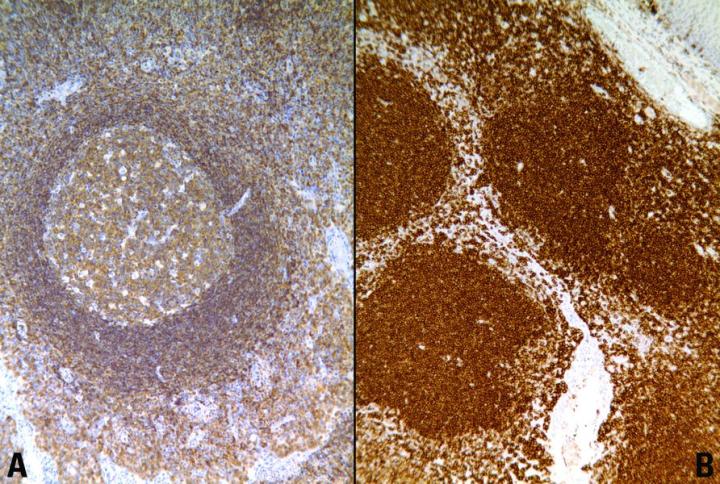 Figure 2. LCA (CD45) staining on reactive tonsil. A. Block fixed for 3 hours in 10% formal saline showing weak demonstration of lymphocytes. B. Block fixed for 8 hours in 10% formal saline showing strong staining of lymphocytes. Figure 2. LCA (CD45) staining on reactive tonsil. A. Block fixed for 3 hours in 10% formal saline showing weak demonstration of lymphocytes. B. Block fixed for 8 hours in 10% formal saline showing strong staining of lymphocytes.