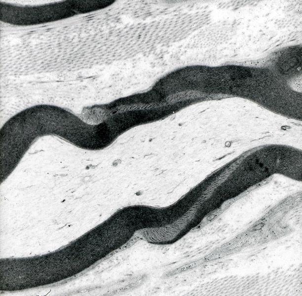 Figure 3: An electron micrograph showing a Schmidt-Lanterman incisure in a myelinated nerve fibre. This specimen was fixed in buffered glutaraldehyde, washed in buffer then given secondary fixation in buffered osmium tetroxide, a standard procedure when preparing specimens for transmission electron microscopy. The multiple layers of phospholipid membrane forming the myelin sheath are well-preserved by this procedure. Figure 3: An electron micrograph showing a Schmidt-Lanterman incisure in a myelinated nerve fibre. This specimen was fixed in buffered glutaraldehyde, washed in buffer then given secondary fixation in buffered osmium tetroxide, a standard procedure when preparing specimens for transmission electron microscopy. The multiple layers of phospholipid membrane forming the myelin sheath are well-preserved by this procedure.
