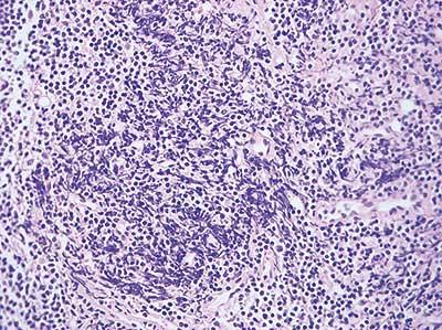 Typical crush artifact is shown in this section of lymphoid tissue. It is characterized by dark, distorted cell nuclei, some of which are extremely elongated and intensely basophilic.