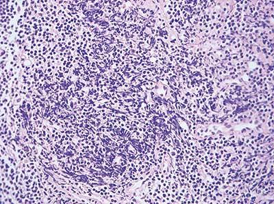 Typical crush artifact is shown in this section of lymphoid tissue. It is characterized by dark, distorted cell nuclei, some of which are extremely elongated and intensely basophilic. Typical crush artifact is shown in this section of lymphoid tissue. It is characterized by dark, distorted cell nuclei, some of which are extremely elongated and intensely basophilic.