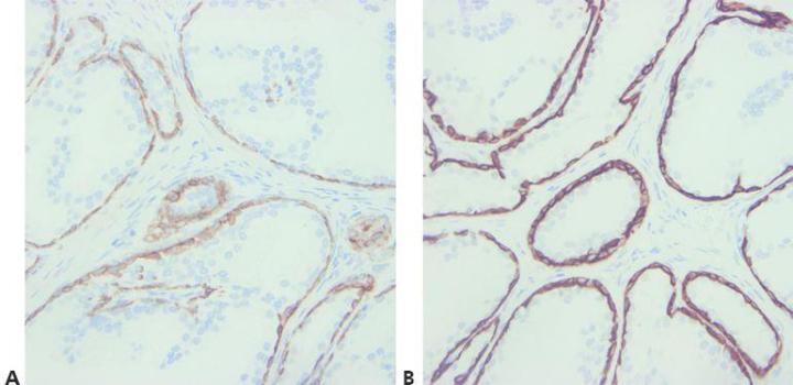 对前列腺切片进行细胞角蛋白 34βE12 染色。 切片 A 显示出弱染色，而切片 B 染色更强且更准确。 两者之间唯一的区别是所用抗原修复方法不同。