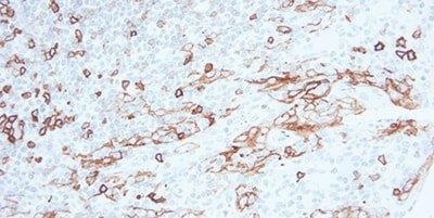 显示位于扁桃体隐窝底部的腭扁桃体 CD5 染色，这是一种主要染色 T 细胞的淋巴细胞标志物。 这种特殊克隆抗体 (4C7) 与隐窝深部的上皮细胞发生交叉反应。