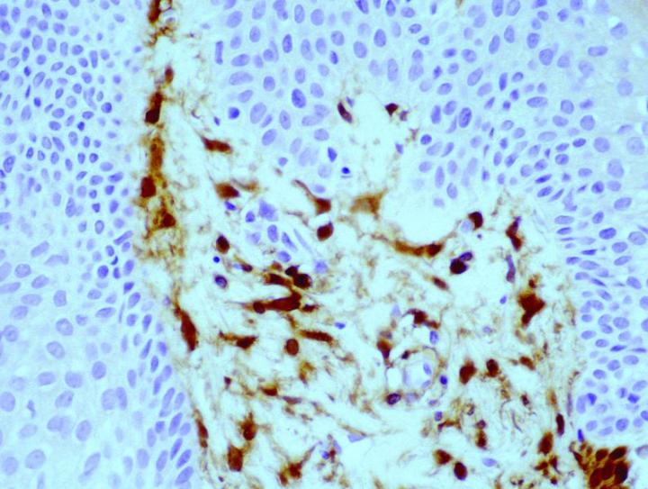 Figure 1. Positive labelling of dermal dendrocytes (FXIIIa +) cells within the papillary dermis in normal skin. Mag X100. Positive labelling of dermal dendrocytes (FXIIIa +) cells within the papillary dermis in normal skin. X100 Magnification.