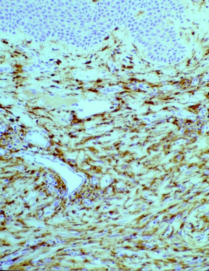 Figure 2. Cellular dermatofibroma (DF) labelling with anti-FXIIIa demonstrating widespread positivity of benign tumour cells. Mag X60. Figure 2. Cellular dermatofibroma (DF) labelling with anti-FXIIIa demonstrating widespread positivity of benign tumor cells. Mag X60.