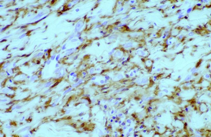 Figure 3. Higher power of Figure 2 demonstrating predominantly cytoplasmic labelling of tumor cells. Mag X100. Higher power demonstrating predominantly cytoplasmic labelling of tumor cells. Magnification at X100.