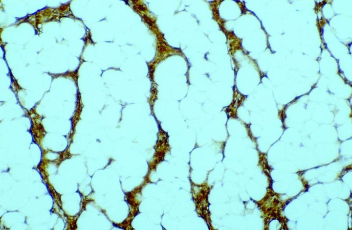 Figure 5. Same case as in Figure 4, demonstrating CD34-positive tumor cells invading into the subcutaneous fat. Mag X100. Figure 5. Same case as in Figure 4, demonstrating CD34-positive tumor cells invading into the subcutaneous fat. Magnification at 100x.