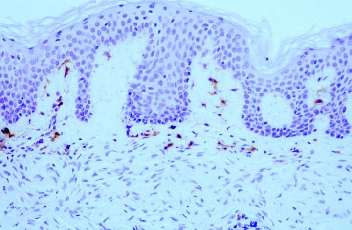 Figure 6. Same case as in Figures 4 & 5 demonstrating anti-FXIIIa labelling of dermal dendrocytes overlying and at the periphery of the invasive tumor cells. Mag X60. Figure 6. Same case as in Figures 4 & 5 demonstrating anti-FXIIIa labelling of dermal dendrocytes overlying and at the periphery of the invasive tumor cells. Magnification at 60x.