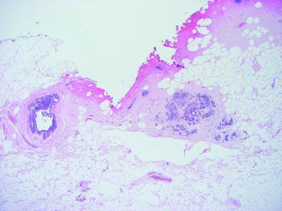 A localized area at the edge of this breast specimen exhibits strong acidophilia with a loss of nuclear and cytoplasmic detail. These effects are the result of heat damage caused when cautery was used during the removal of the specimen. Adjacent glandular