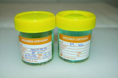 Specimens with incomplete labels such as these, should not be accepted by a laboratory. A procedure must be in place to deal with specimens that arrive at the lab inadequately labeled or accompanied by incomplete or inconsistent documentation.