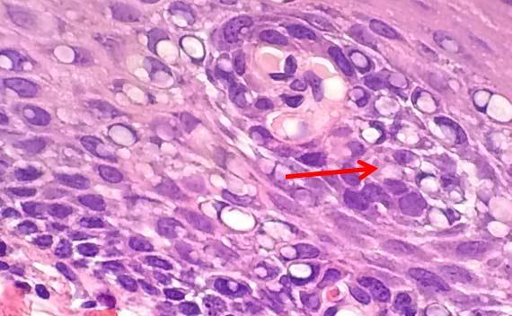 Figure 10 The bubbling is clear in this image. High heat and acidic formalin can cause protein coagulation that may impair diagnosis.