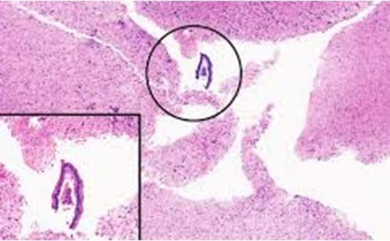 Figure 11 This section of brain tissue has an extraneous piece of enteric tissue. Most likely, the contamination occurred during specimen grossing, there is no way to confirm its origin. Photo Credit: Sehn, JK et. al., Occult Specimen Contamination in Routine Clinical Next-Generation Sequencing Testing. Am J ClinPathol October 2015; 144:667-674.