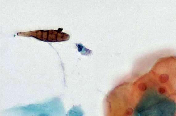 Hình 13 Alternaria, một loại nấm trong không khí, được thấy trên phết tế bào Pap.  Tín dụng hình ảnh: http://pathos223.com/en/case/case237.htm