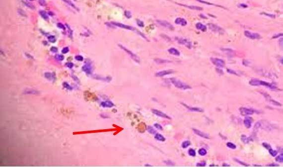Figure 15 Hemosiderin pigment on a section of tissue.