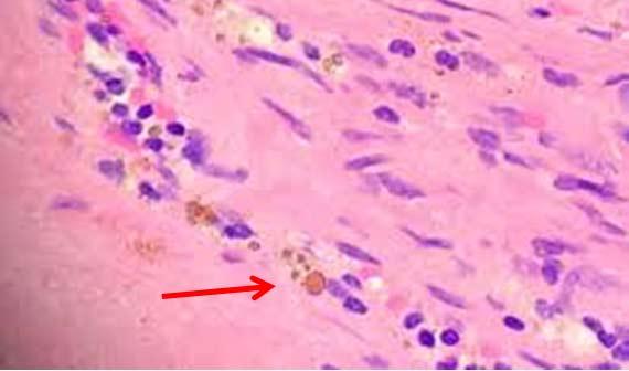 Figura 15 Pigmento de hemosiderina en una sección de tejido.