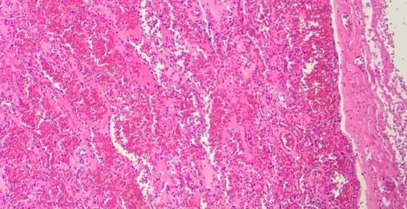 Figure 4 Cracking of the RBCs can be easily seen from lower magnification.