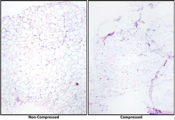 Figure 9 This image shows the compression of under processed tissues. Note how the slide on the right is damaged and the details of the fat cells are compromised, indicating that the sample was not properly infiltrated. Photo credit: Stanley Hansen