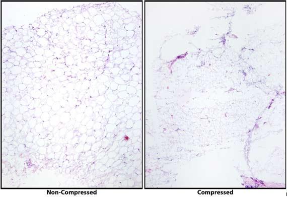Hình 9 Hình ảnh này cho thấy sự nén của các mô được xử lý. Lưu ý tấm trượt bên phải bị hỏng như thế nào và các chi tiết của tế bào mỡ bị tổn hại, cho thấy mẫu không được thấm đúng cách. Nguồn ảnh: Stanley Hansen