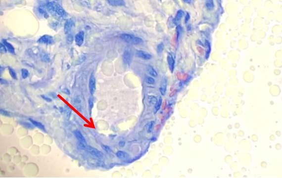 Información fundamental sobre la tinción Hematoxilina-Eosina (H&E), Parte 4: Resolución de problemas con las tinciones con H&E