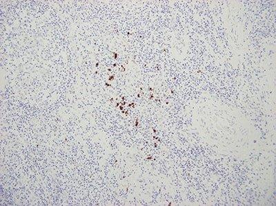 This negative control section of tonsil has gone through all steps of ISH but without the application of a probe. It shows hemosiderin, which has a natural brown color and additionally binds DAB which intensifies the color. This does not represent positive staining.