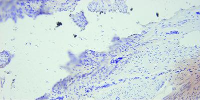 This poor quality section shows lifting and background staining (HPV).