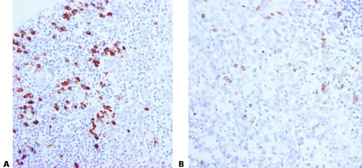 A 固定良好的扁桃体组织 κ 轻链 mRNA ISH 显示出明显的强阳性反应。 B 固定不佳的扁桃体组织 κ 轻链 mRNA ISH 显示出弱阳性反应。